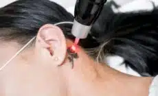 L'utilisation du laser dans les differents traitements de chirurgie esthetique